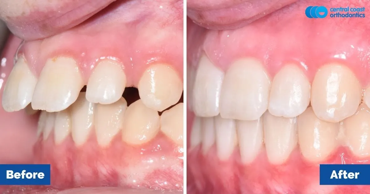 Before and after comparison, side view of the upper and lower teeth