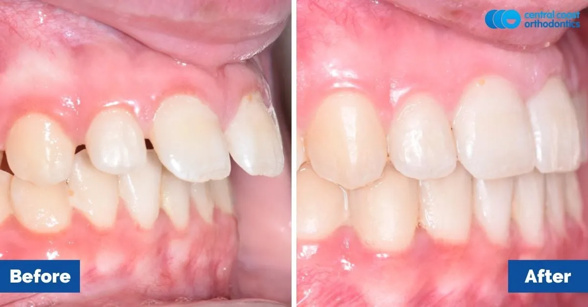 Before and after comparison, side view of the upper and lower teeth