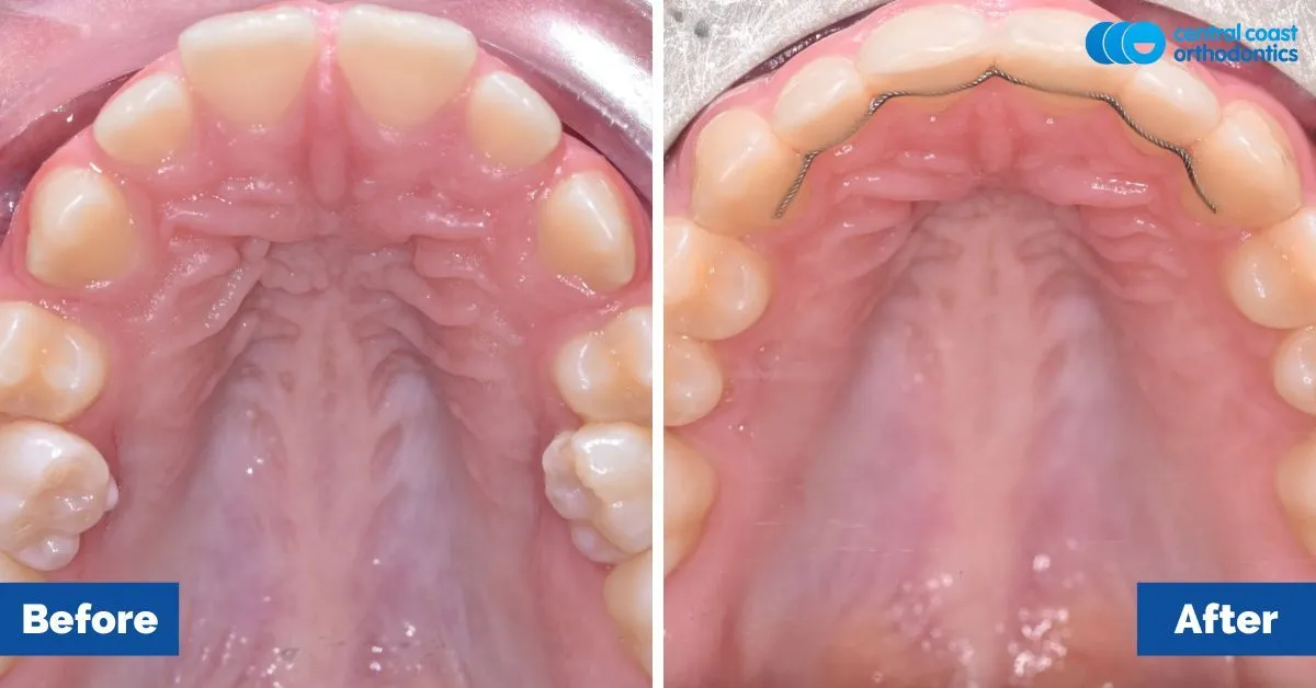 Before and after comparison, upper teeth viewed from below