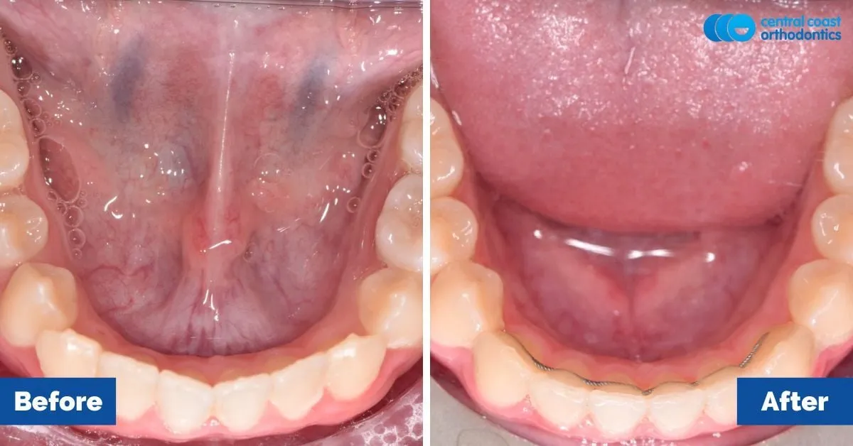 Before and after comparison, lower teeth viewed from above