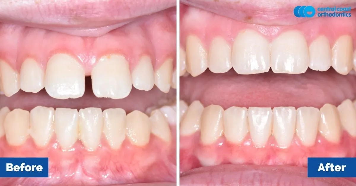 Before and after comparison, front view of the upper and lower teeth