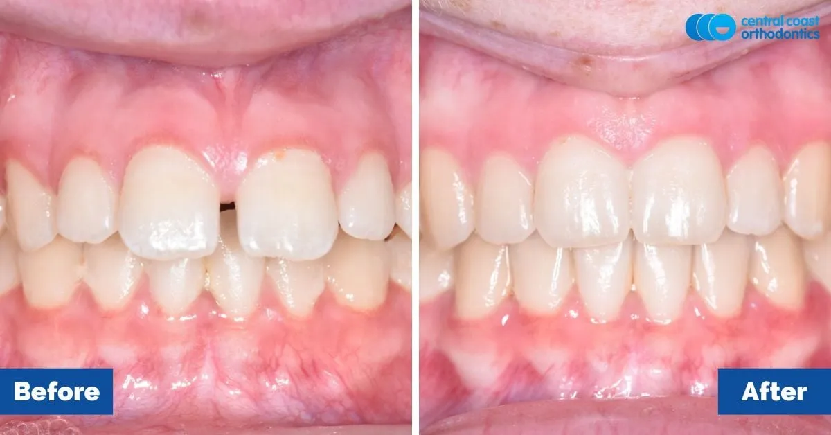 Before and after comparison, front view of the upper and lower teeth
