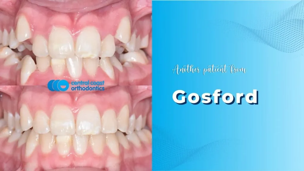 Before and after photographs of a Central Coast Orthodontics patient's teeth, labelled Gosford