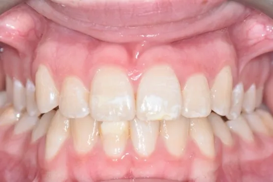 Patient of Gosfordu2019s Invisalign Makeover