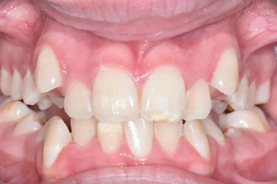 Patient of Gosfordu2019s Invisalign Makeover