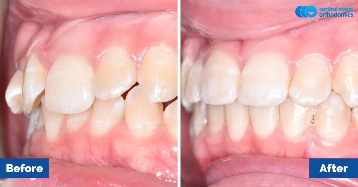 Before and after comparison, side view of the upper and lower teeth