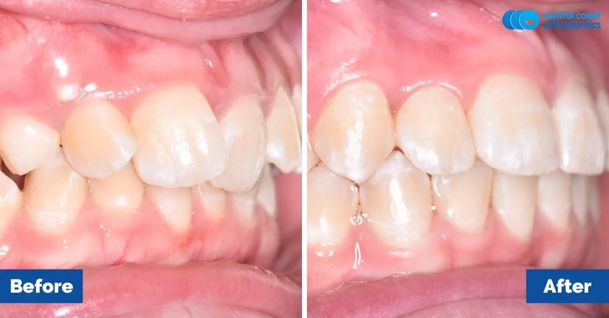Before and after comparison, side view of the upper and lower teeth