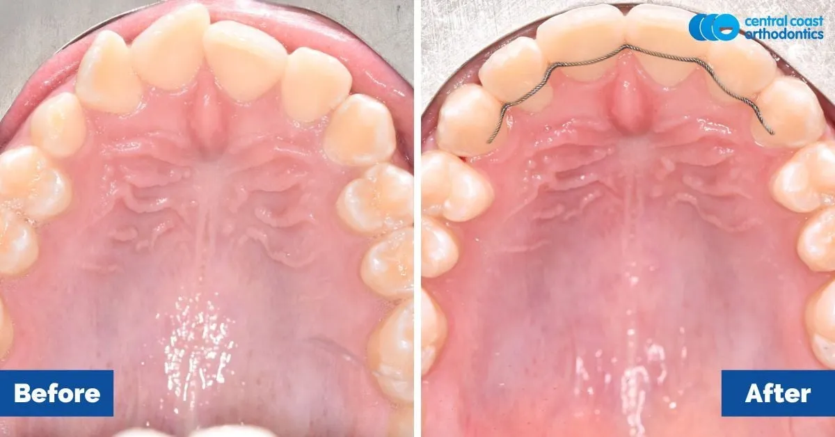 Before and after comparison, upper teeth viewed from below