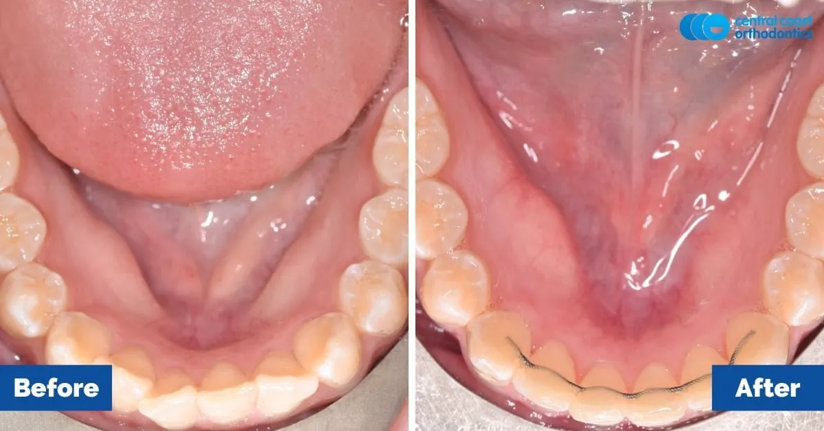 Before and after comparison, lower teeth viewed from above