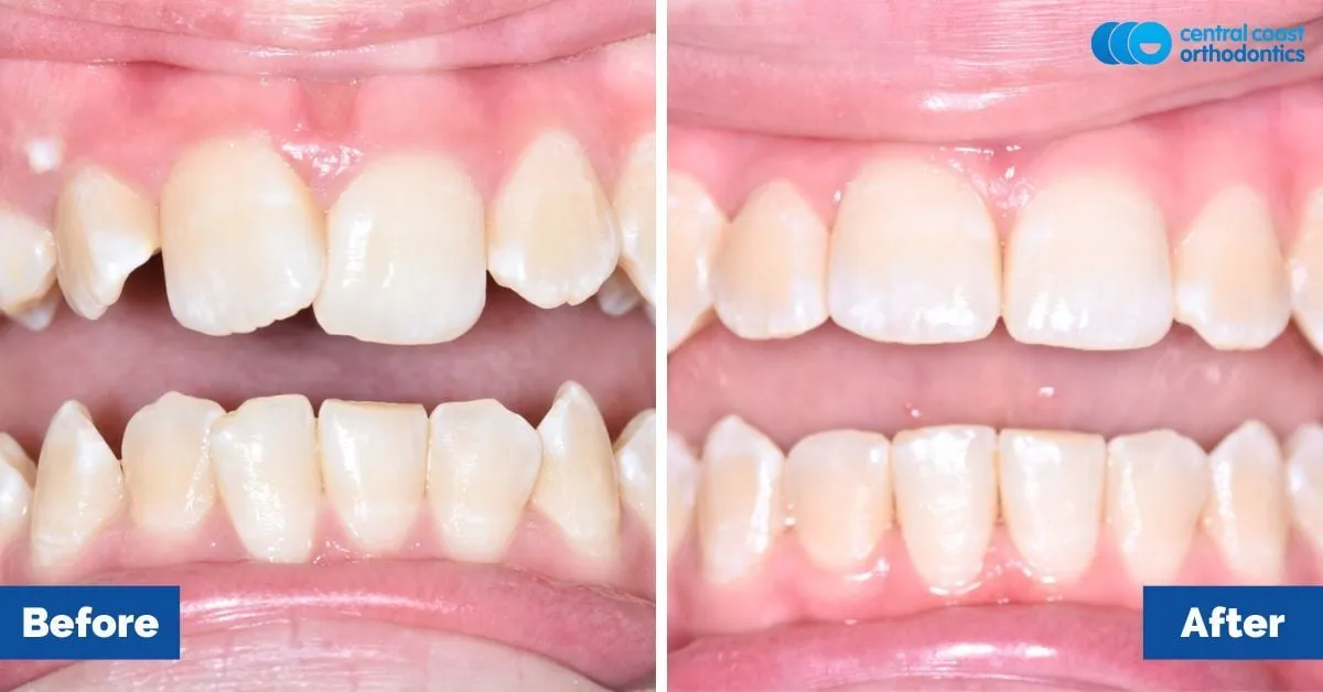Before and after comparison, front view of the upper and lower teeth
