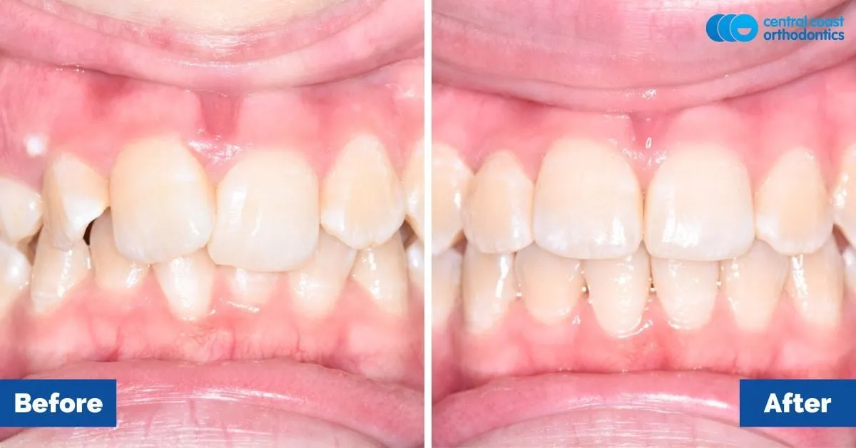 Before and after comparison, front view of the upper and lower teeth