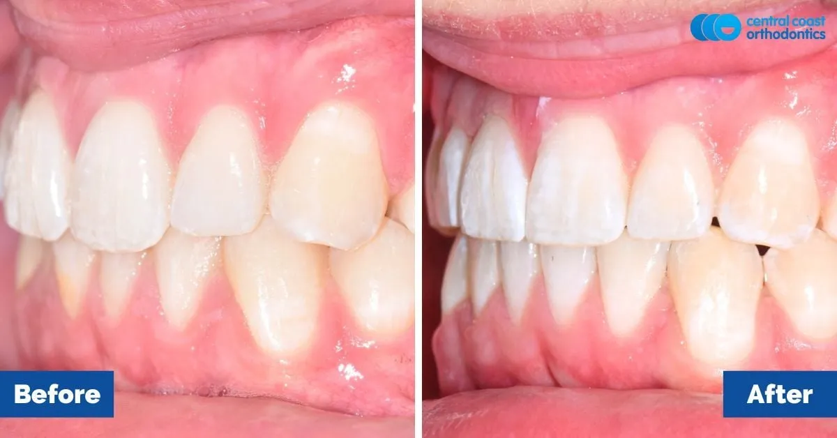 Before and after comparison, right side view of the upper and lower teeth