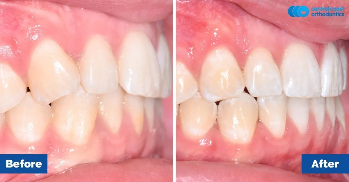 Before and after comparison, front view of the upper and lower teeth