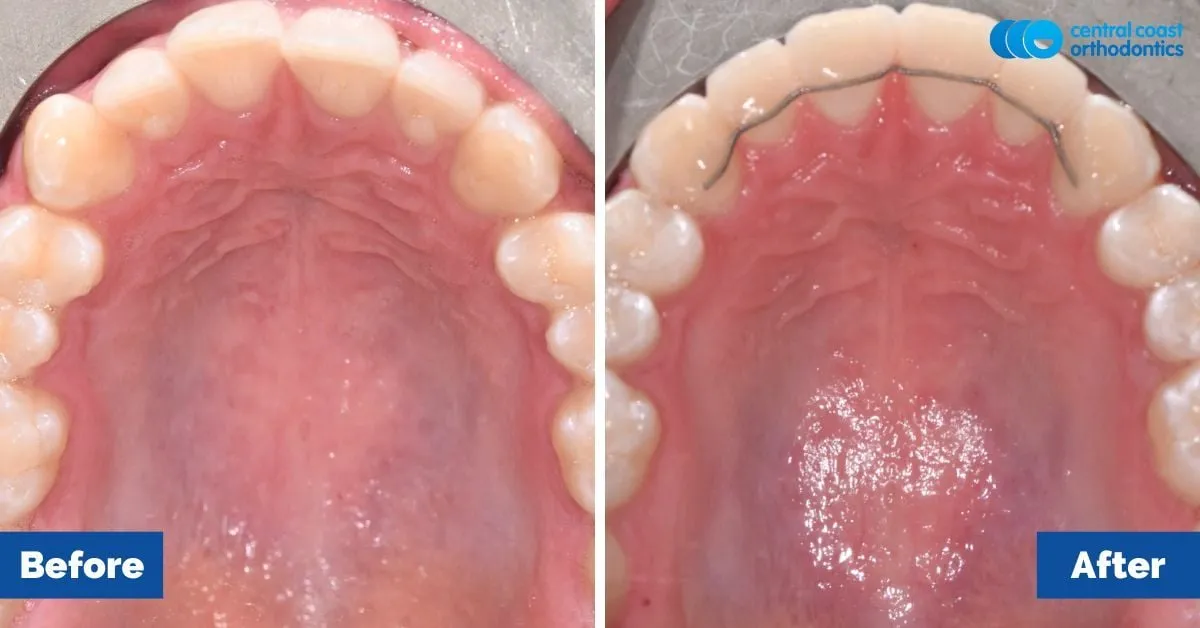 Before and after comparison, upper teeth viewed from below