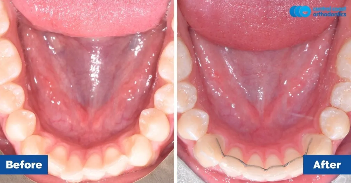 Before and after comparison, lower teeth viewed from above