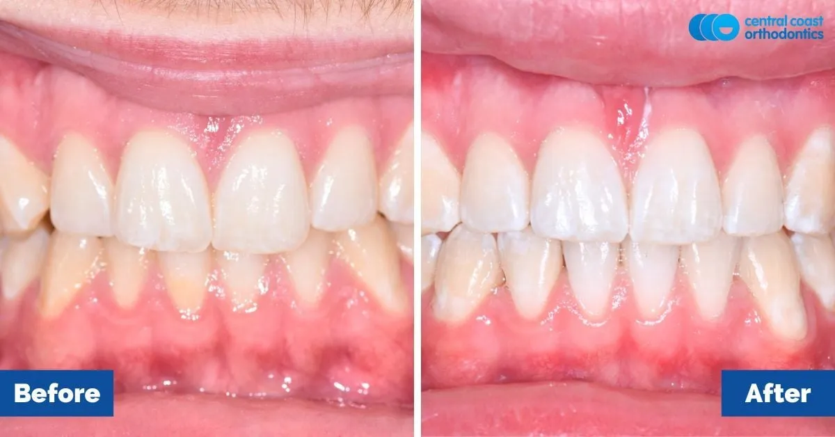 Before and after comparison, left side view of the upper and lower teeth