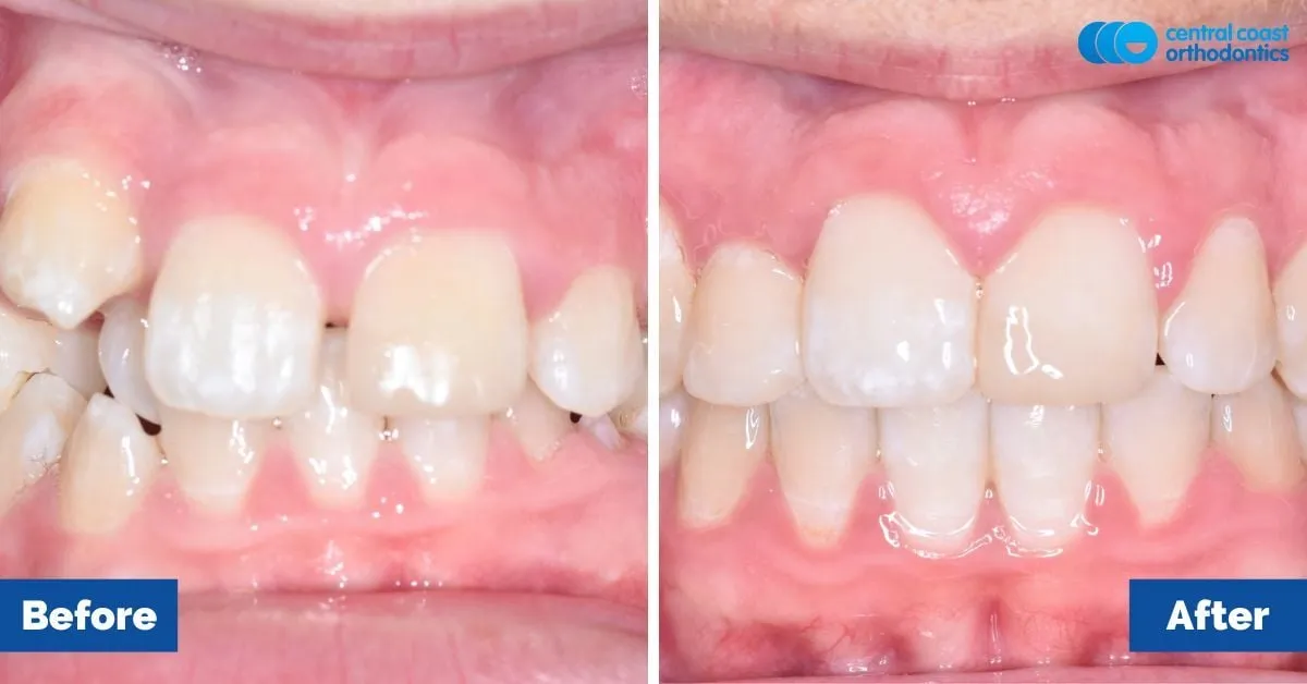 Before and after comparison, front view of the upper and lower teeth
