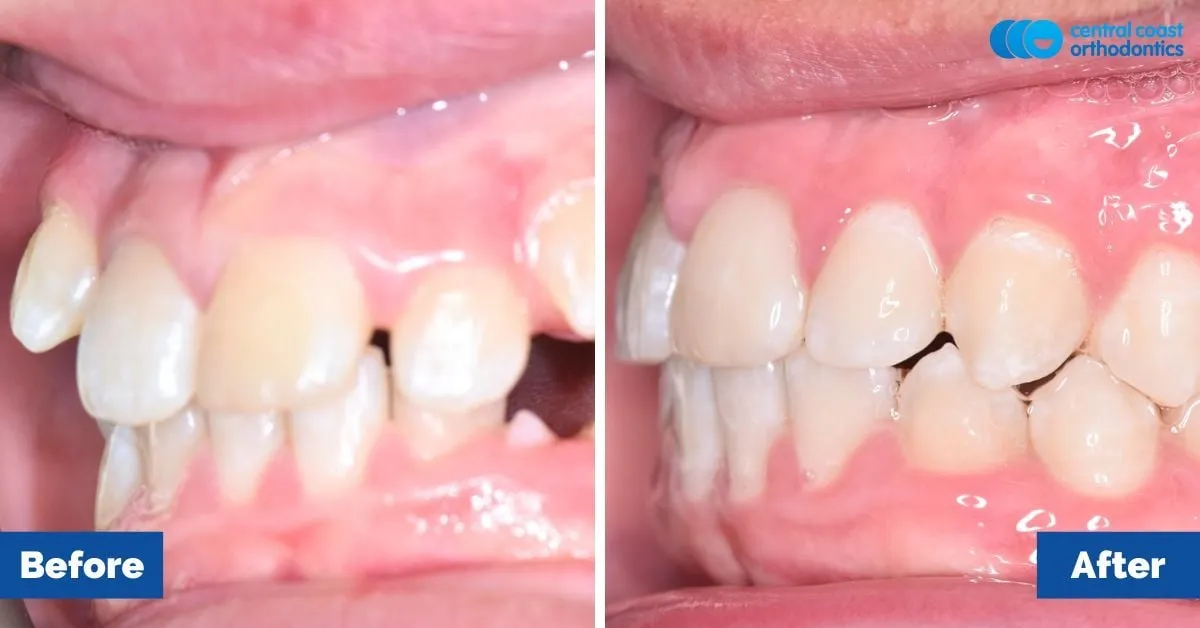 Before and after comparison, side view of the upper and lower teeth