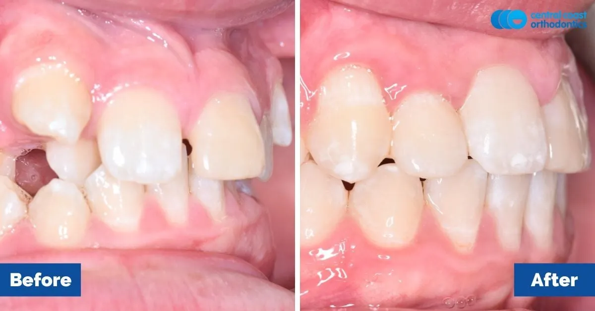 Before and after comparison, side view of the upper and lower teeth