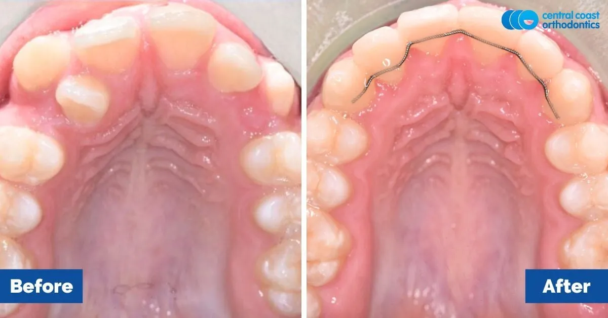 Before and after comparison, upper teeth viewed from below