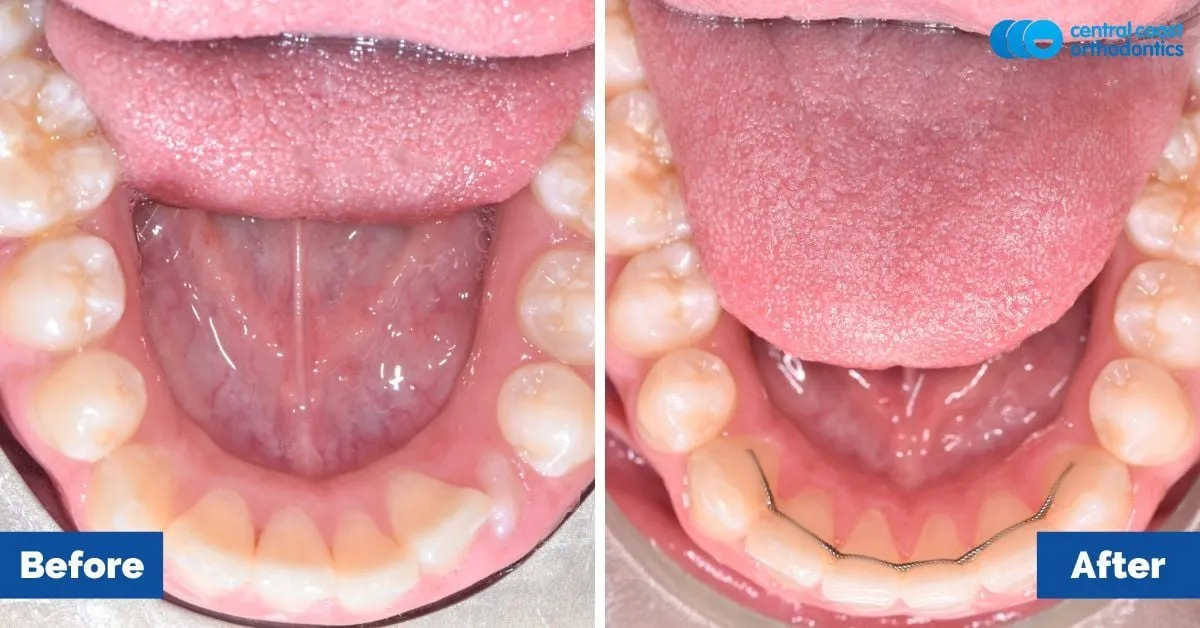 Before and after comparison, lower teeth viewed from above