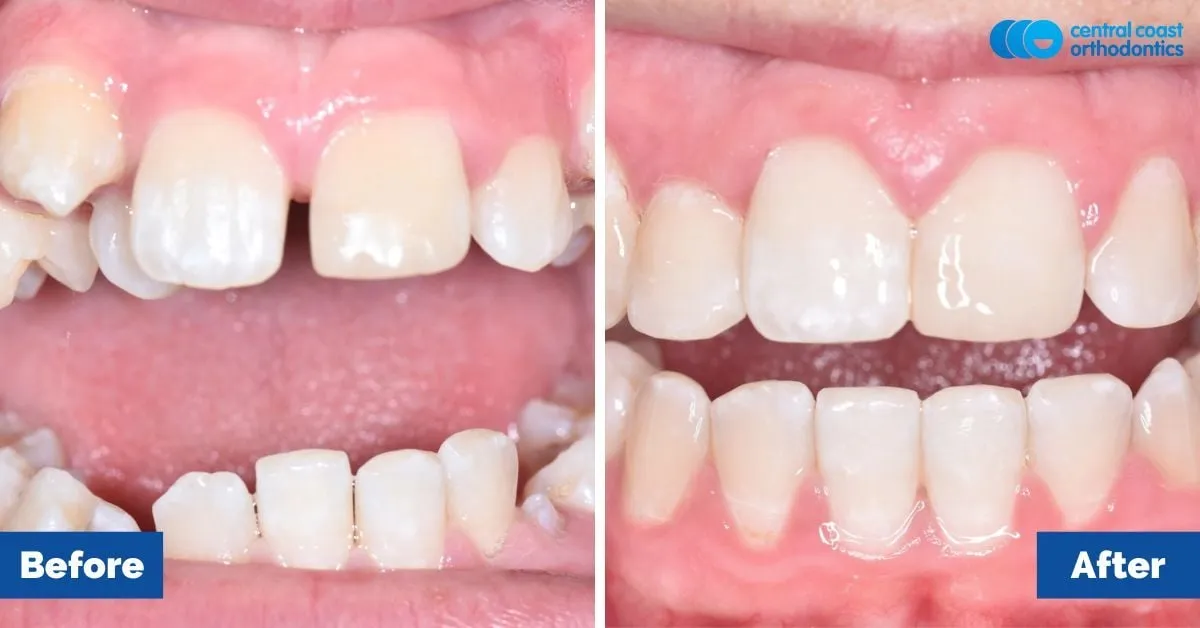 Before and after comparison, front view of the upper and lower teeth