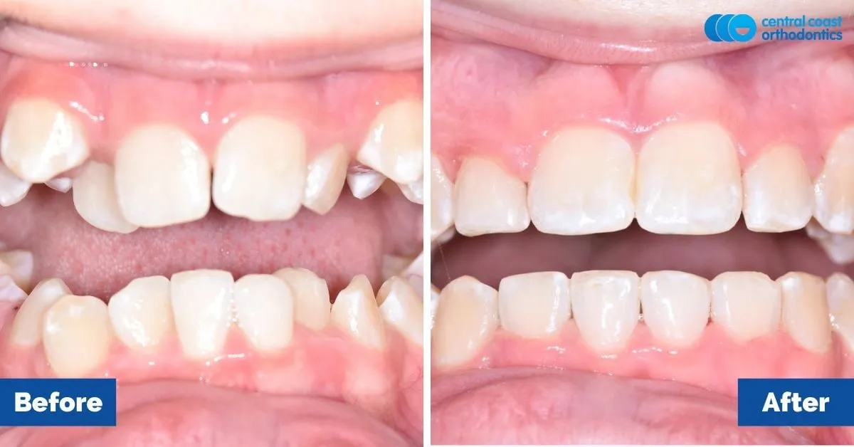 Before and after comparison, front view of the upper and lower teeth
