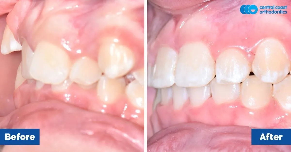 Before and after comparison, side view of the upper and lower teeth