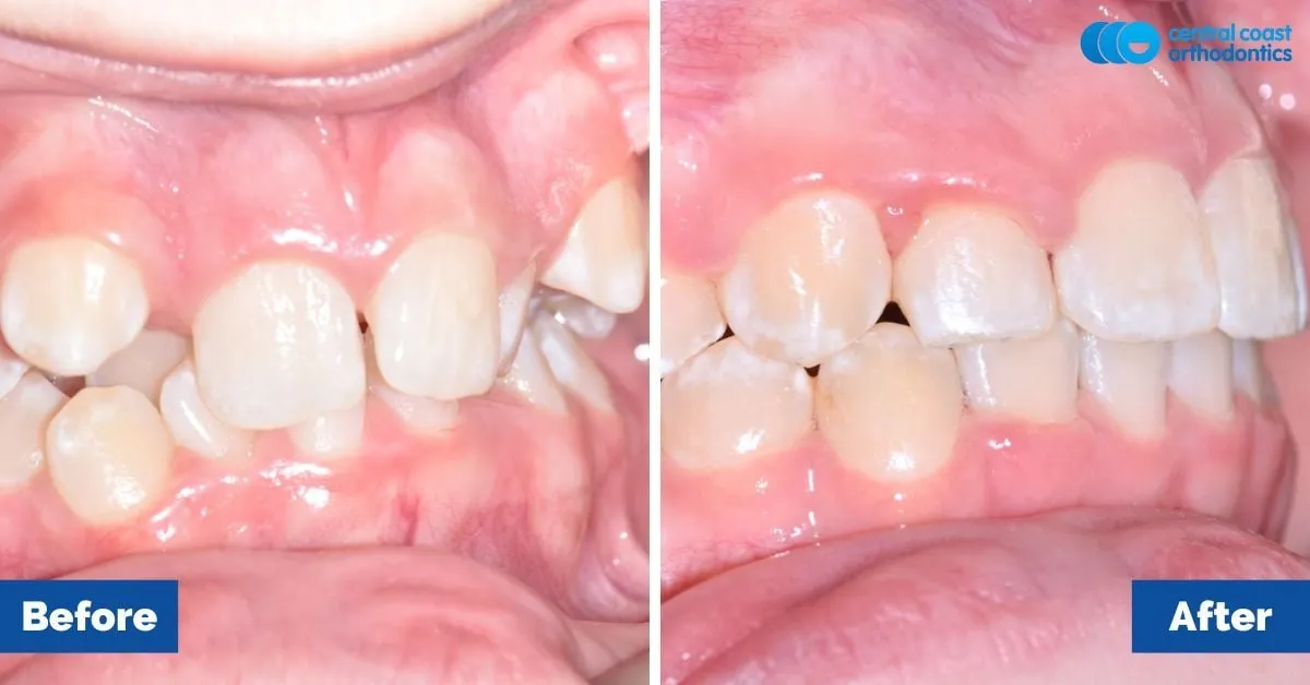 Before and after comparison, side view of the upper and lower teeth