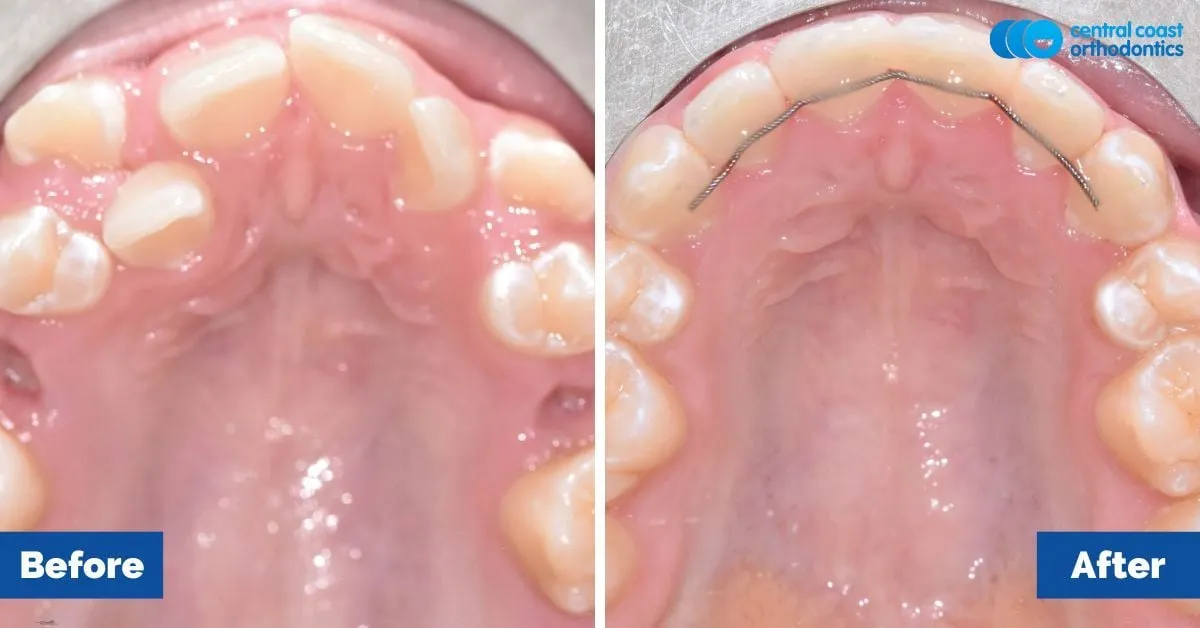 Before and after comparison, upper teeth viewed from below