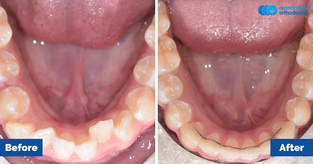 Before and after comparison, lower teeth viewed from above