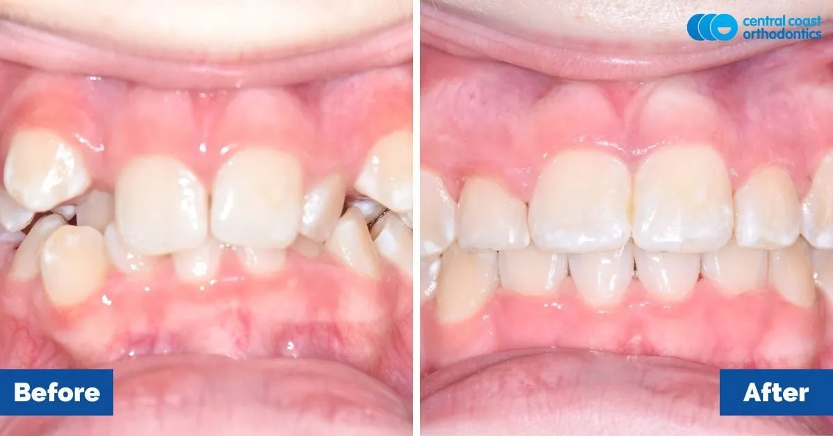Before and after comparison, front view of the upper and lower teeth