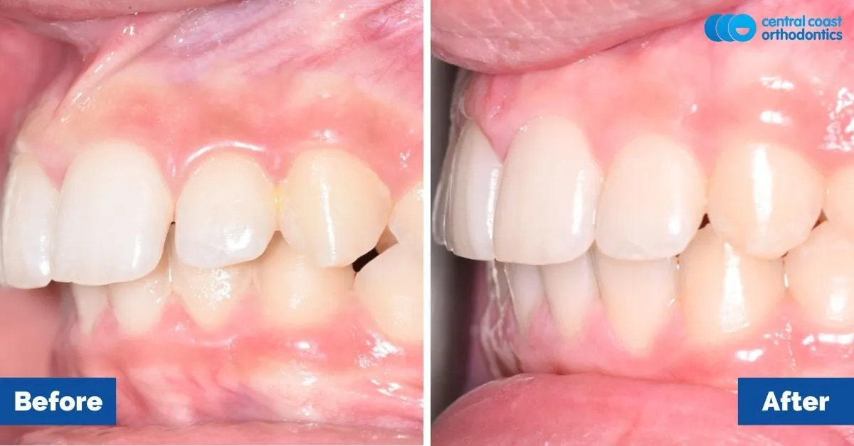 Before and after comparison, side view of the upper and lower teeth