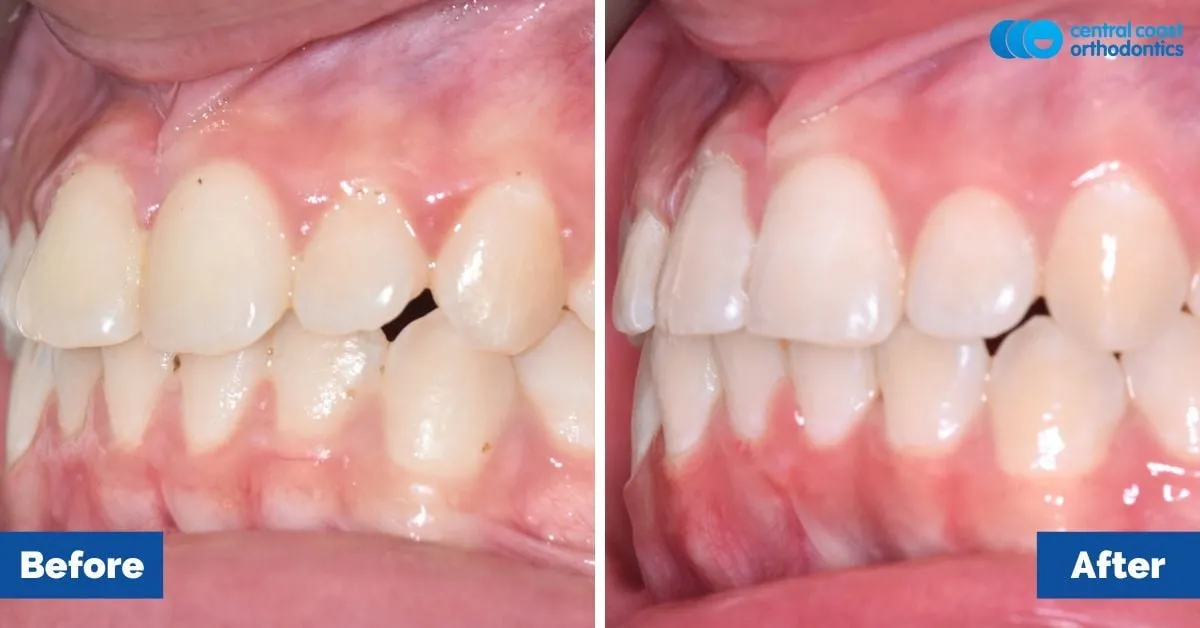 Before and after comparison, front view of the upper and lower teeth