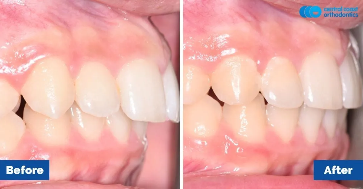 Before and after comparison, side view of the upper and lower teeth