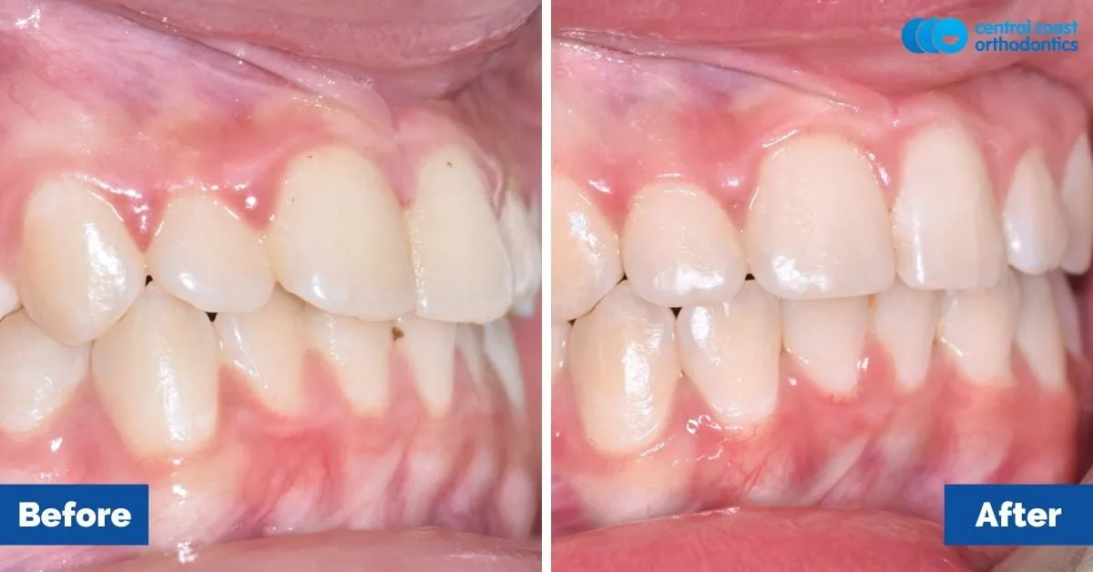 Before and after comparison, side view of the upper and lower teeth