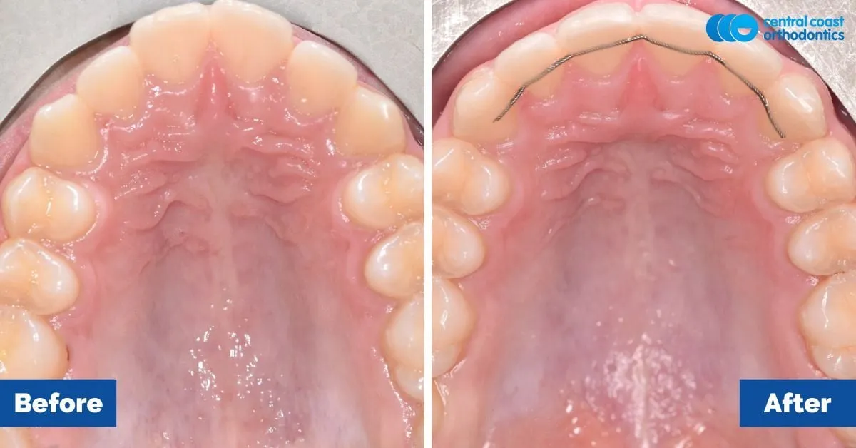 Before and after comparison, upper teeth viewed from below
