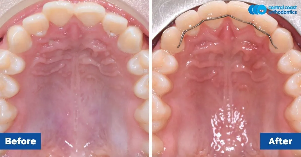 Before and after comparison, upper teeth viewed from below