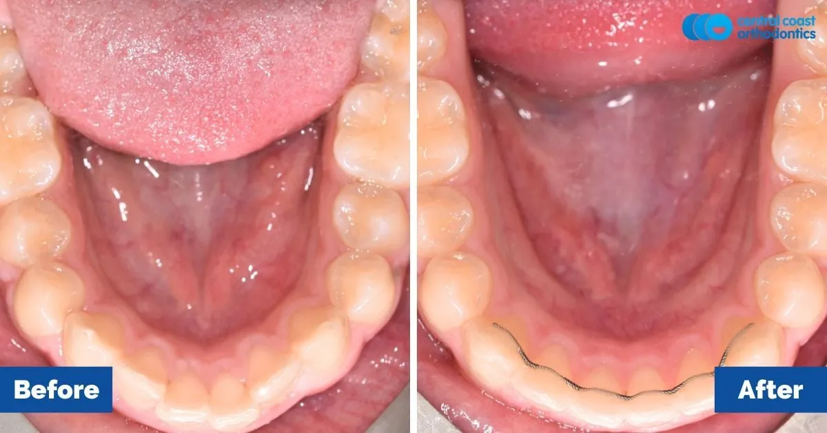 Before and after comparison, lower teeth viewed from above
