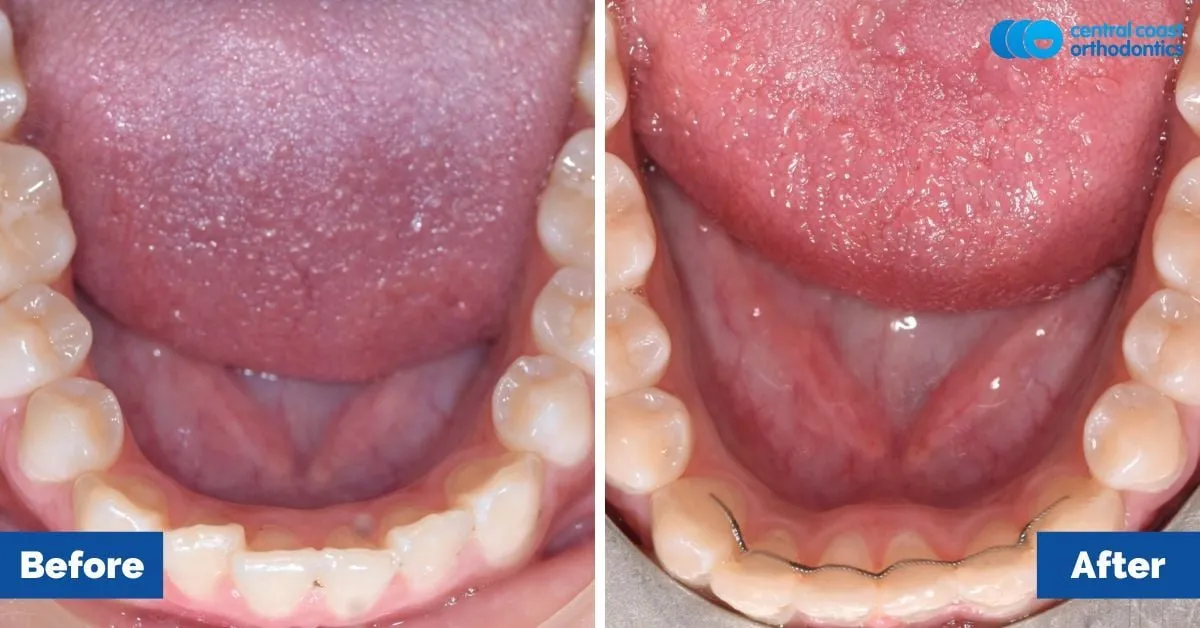 Before and after comparison, lower teeth viewed from above