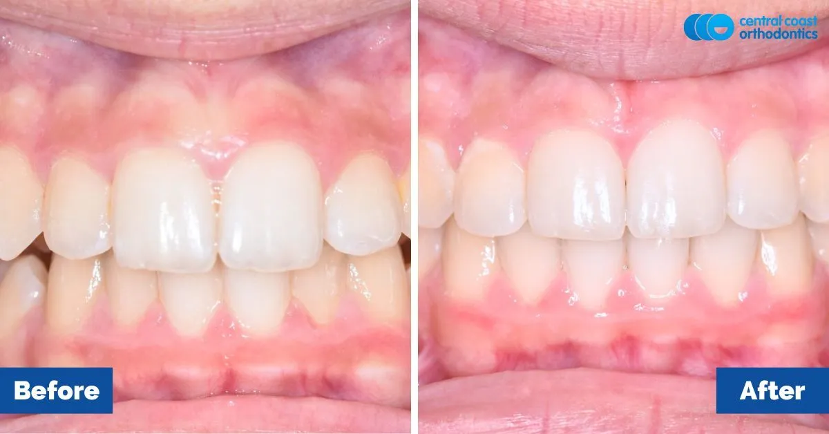 Before and after comparison, front view of the upper and lower teeth