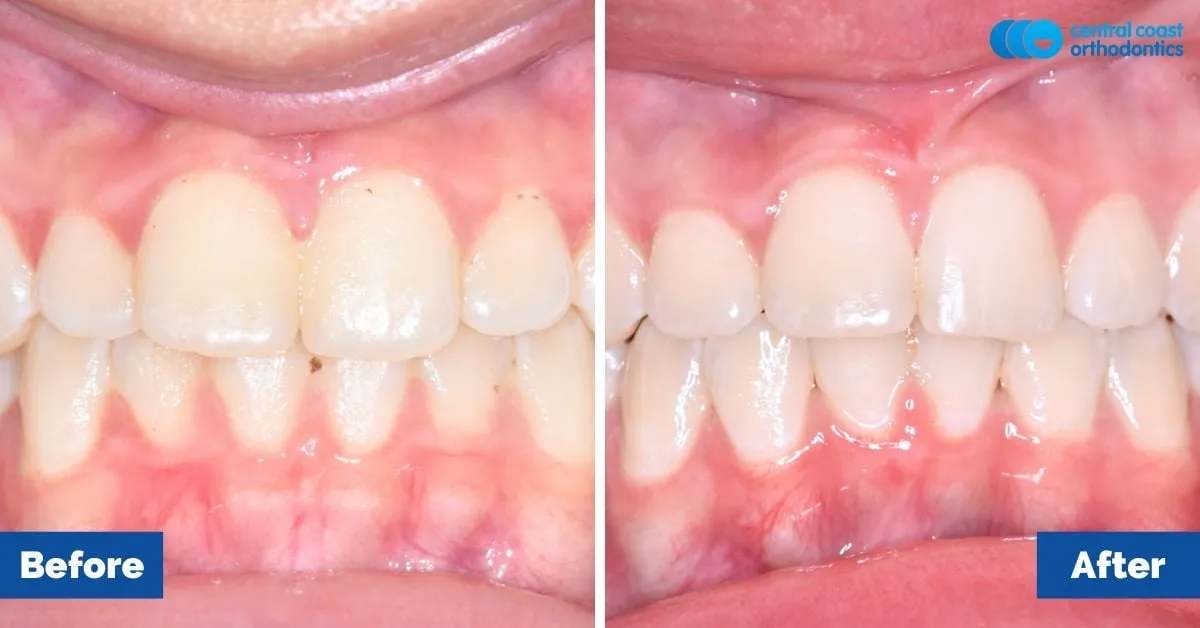 Before and after comparison, front view of the upper and lower teeth