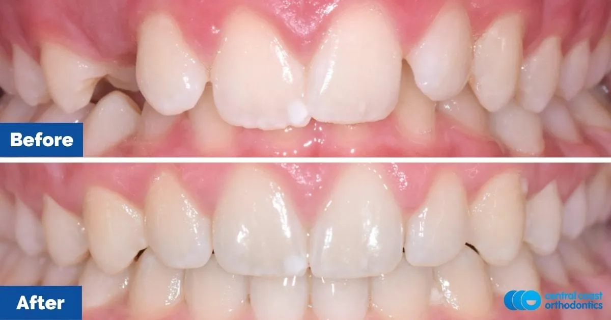 Before and after comparison, front view of the upper and lower teeth