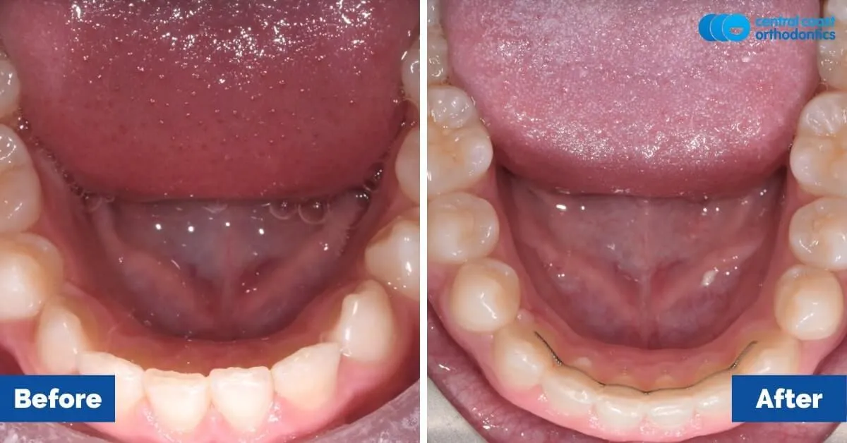 Before and after comparison, lower teeth viewed from above