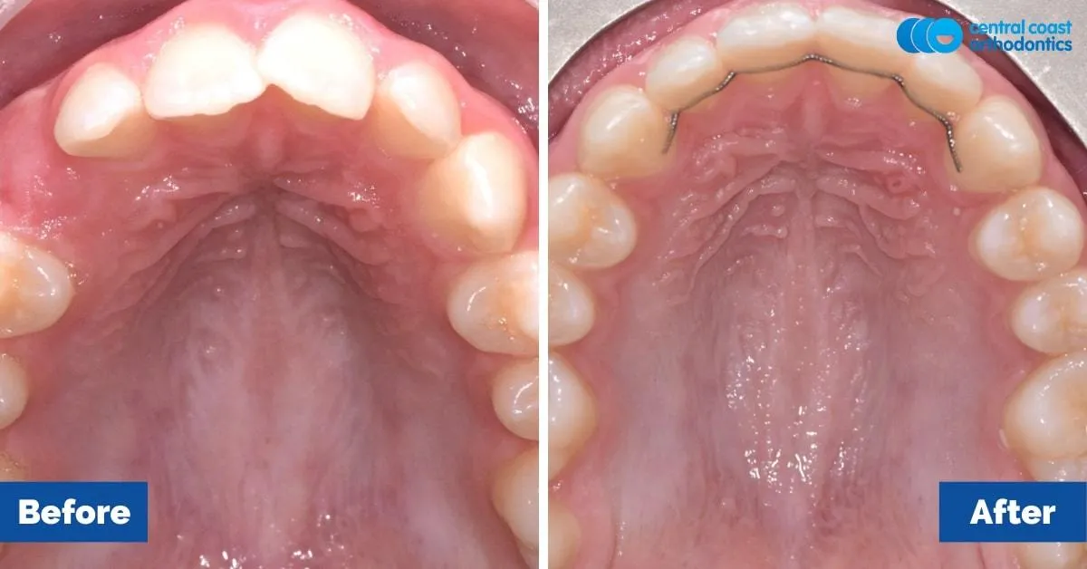 Before and after comparison, upper teeth viewed from below