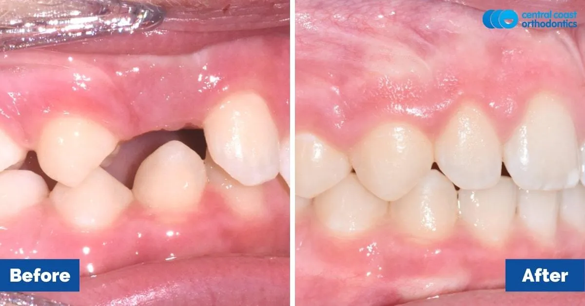 Before and after comparison, side view of the upper and lower teeth