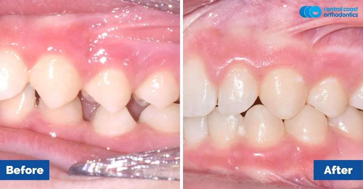 Before and after comparison, side view of the upper and lower teeth
