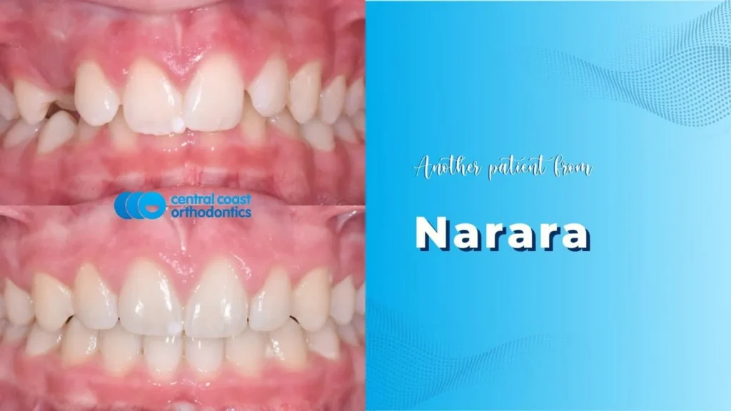 Before and after photographs of a Central Coast Orthodontics patient's teeth, labelled Narara