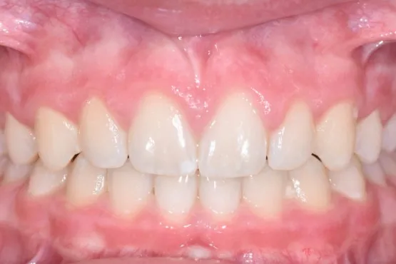 Patient of Nararau2019s Braces Makeover