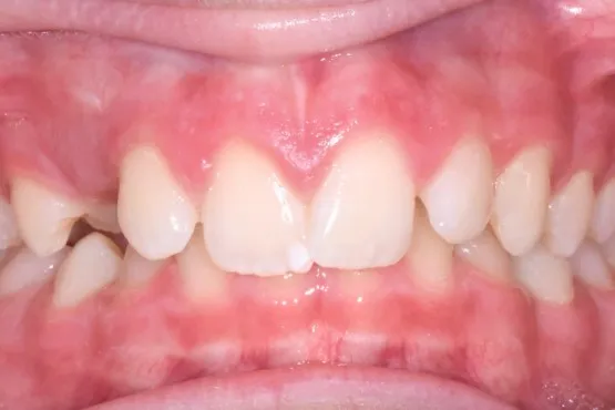 Patient of Nararau2019s Braces Makeover